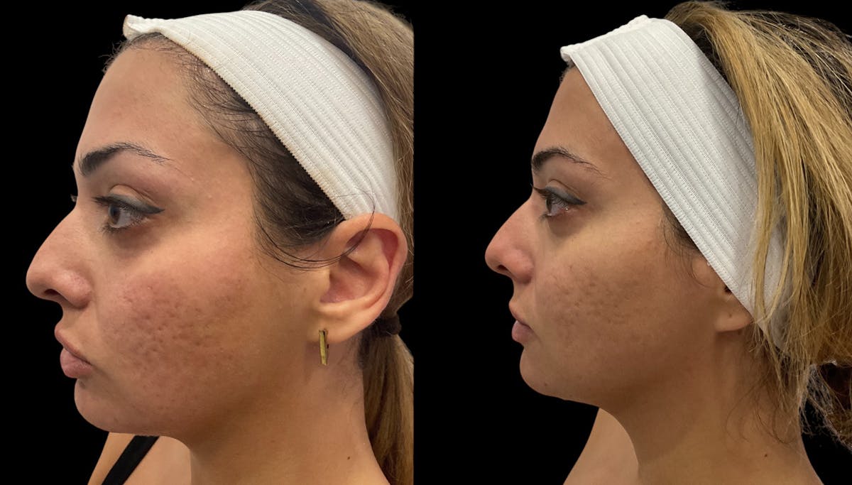 Vivace® Before & After Gallery - Patient 250841 - Image 2