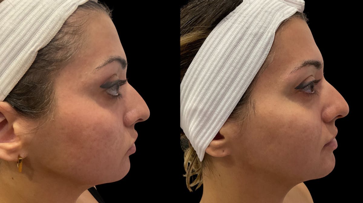 Vivace® Before & After Gallery - Patient 250841 - Image 3