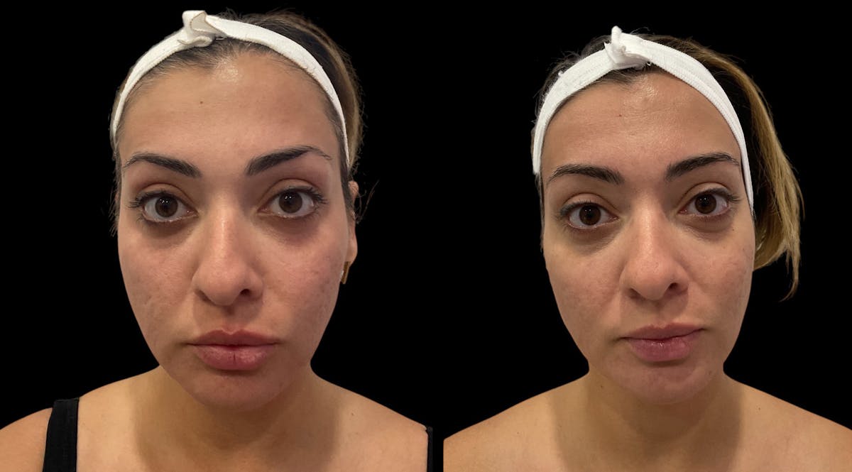 Vivace® Before & After Gallery - Patient 250841 - Image 4