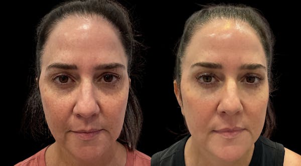 Vivace® Before & After Gallery - Patient 253208 - Image 1