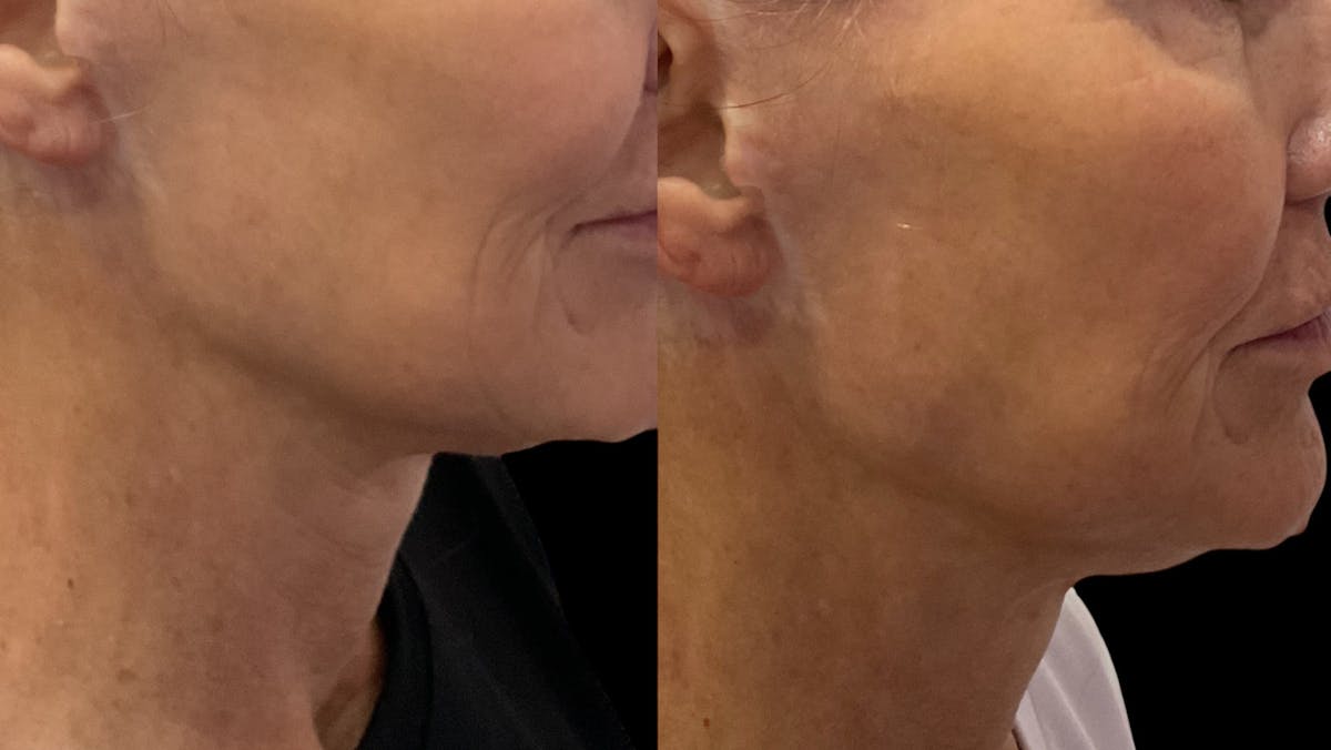 Vivace® Before & After Gallery - Patient 740959 - Image 2
