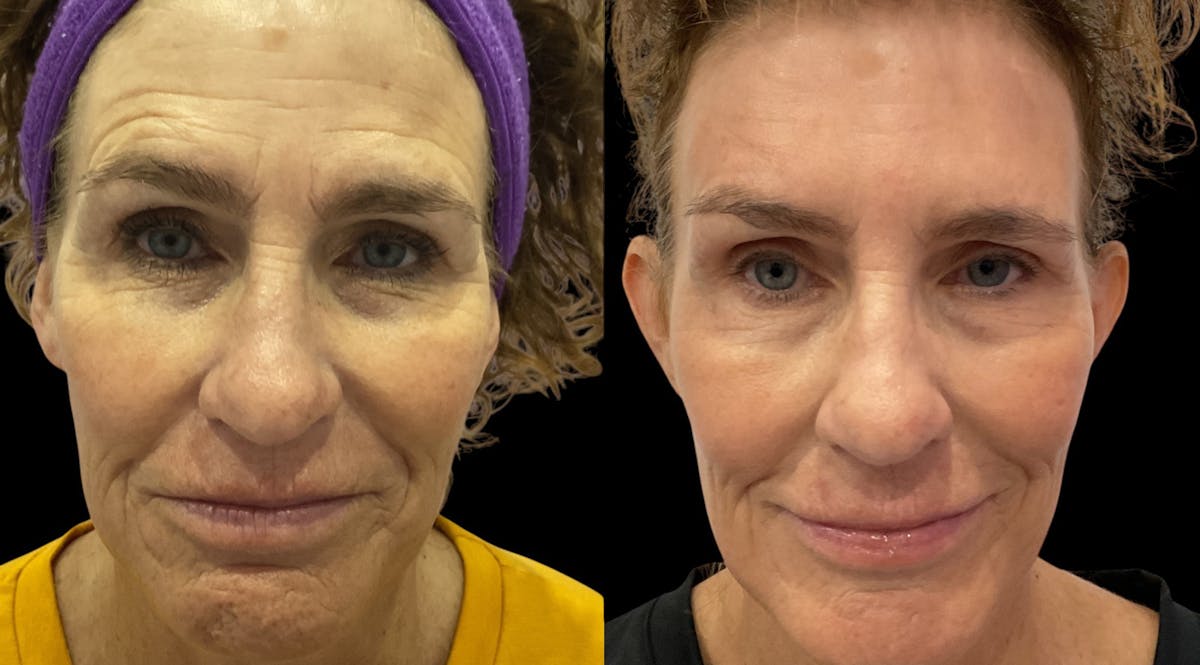 Vivace® Before & After Gallery - Patient 740959 - Image 1