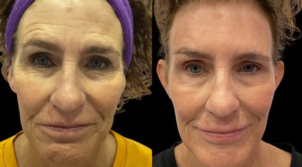 Vivace® Before & After Gallery - Patient 740959 - Image 1