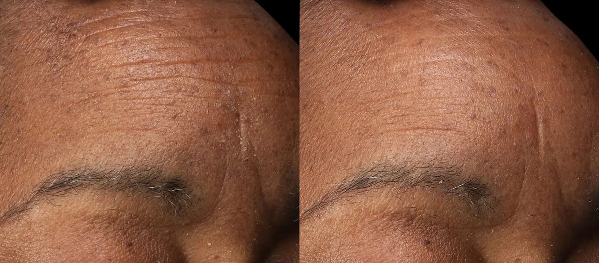 Vivace® Before & After Gallery - Patient 323281 - Image 1