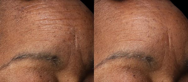 Vivace® Before & After Gallery - Patient 323281 - Image 1