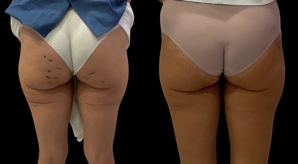 Avéli® Before & After Gallery - Patient 250830 - Image 1