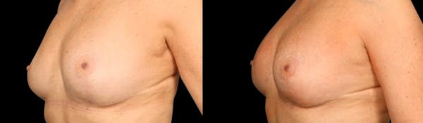 alloClae™ Adipose Filler Before & After Gallery - Patient 168234 - Image 1