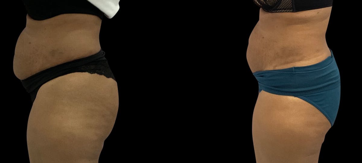Non-Invasive Laser Lipo Before & After Gallery - Patient 263991 - Image 1