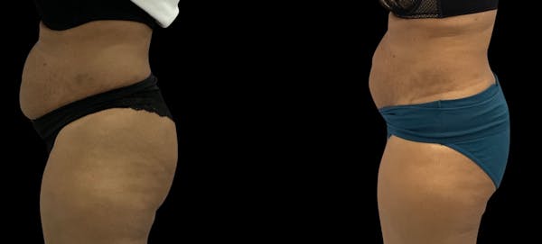 Non-Invasive Laser Lipo Before & After Gallery - Patient 263991 - Image 1