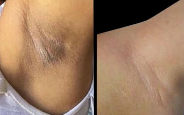Intimate Skin Lightening Before & After Gallery - Patient 417743 - Image 1