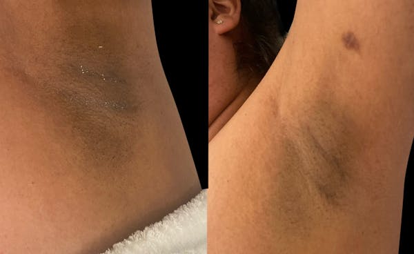 Intimate Skin Lightening Before & After Gallery - Patient 108280 - Image 1