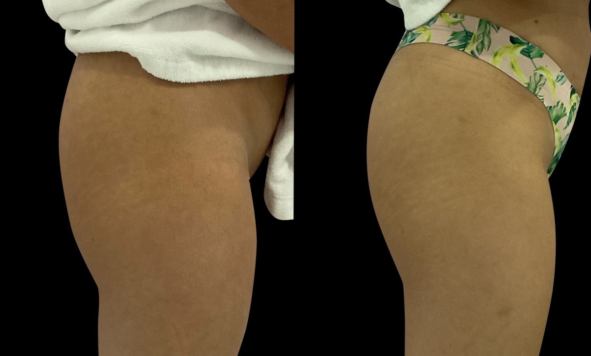 Muscle Building Before & After Gallery - Patient 342424 - Image 2