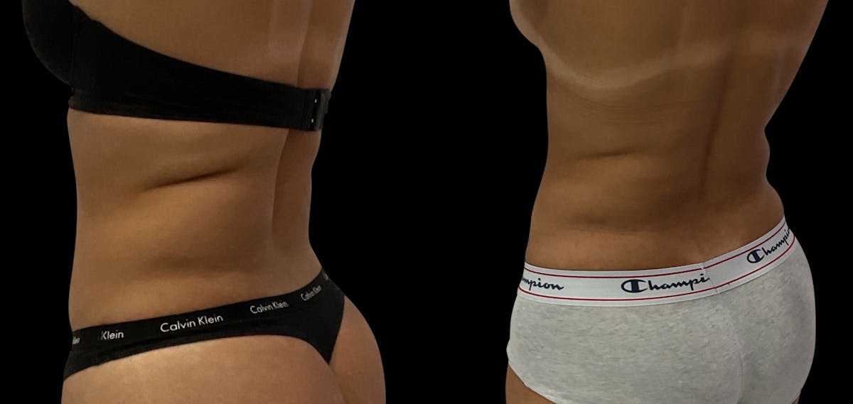 Skin Tightening Before & After Gallery - Patient 382171 - Image 1
