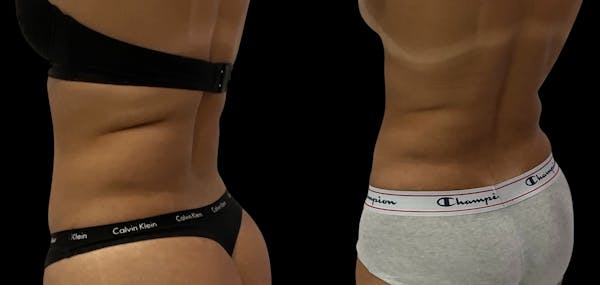 Skin Tightening Before & After Gallery - Patient 382171 - Image 1