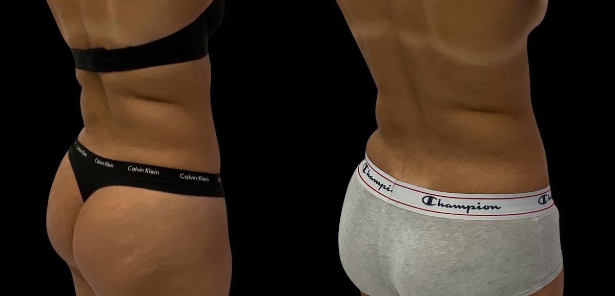 Skin Tightening Before & After Gallery - Patient 382171 - Image 2