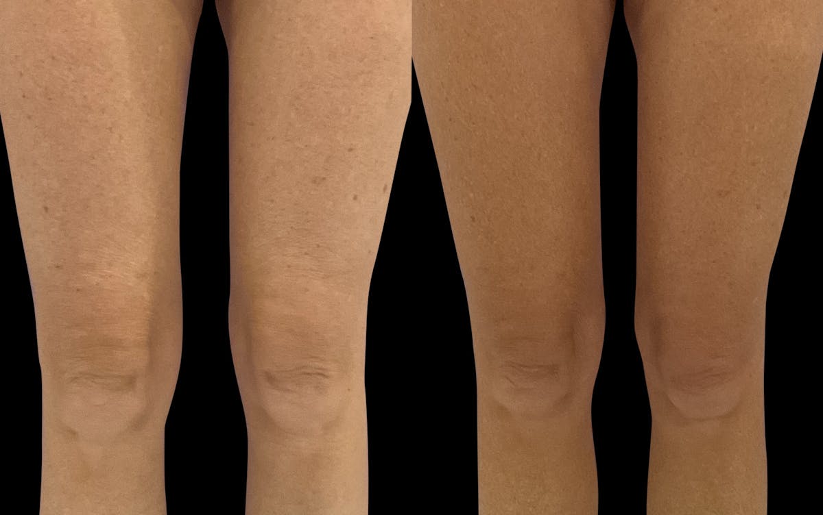 Skin Tightening Before & After Gallery - Patient 183898 - Image 1