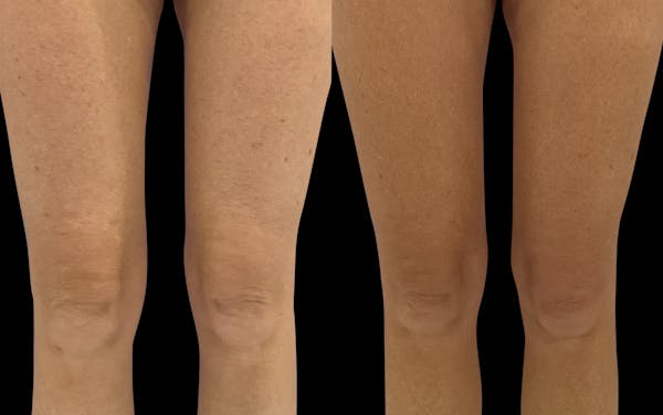 Skin Tightening Before & After Gallery - Patient 183898 - Image 1