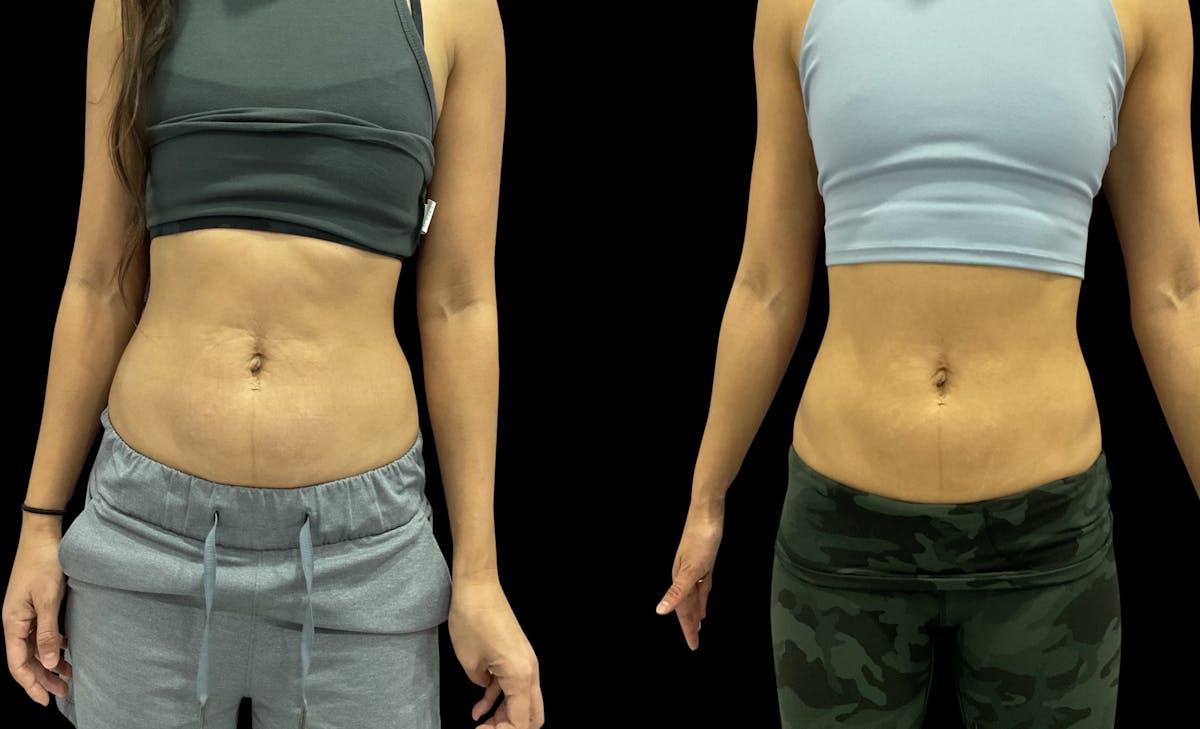 Skin Tightening Before & After Gallery - Patient 185340 - Image 1