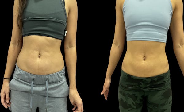 Skin Tightening Before & After Gallery - Patient 185340 - Image 1