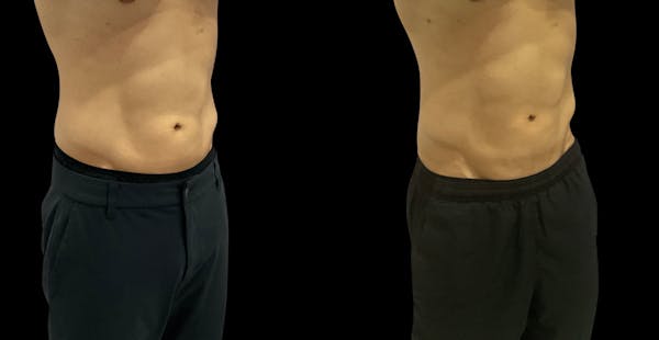 Skin Tightening Before & After Gallery - Patient 128478 - Image 1