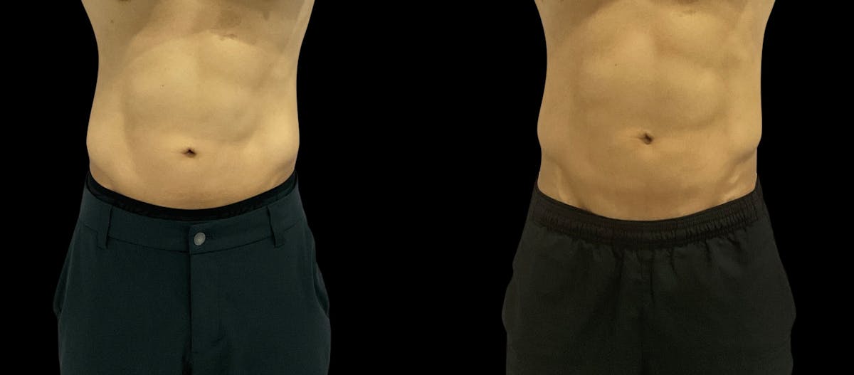 Skin Tightening Before & After Gallery - Patient 128478 - Image 2