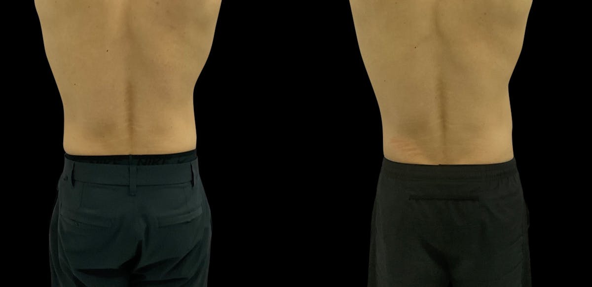 Skin Tightening Before & After Gallery - Patient 128478 - Image 3