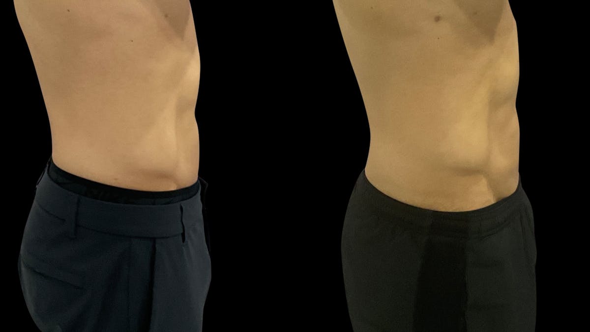 Skin Tightening Before & After Gallery - Patient 128478 - Image 4
