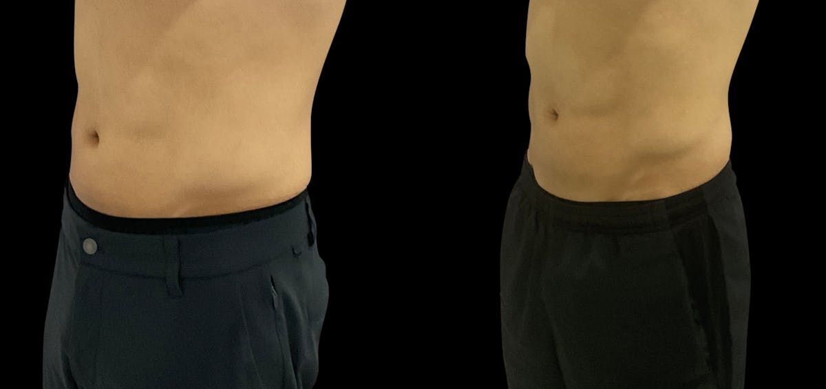 Skin Tightening Before & After Gallery - Patient 128478 - Image 5
