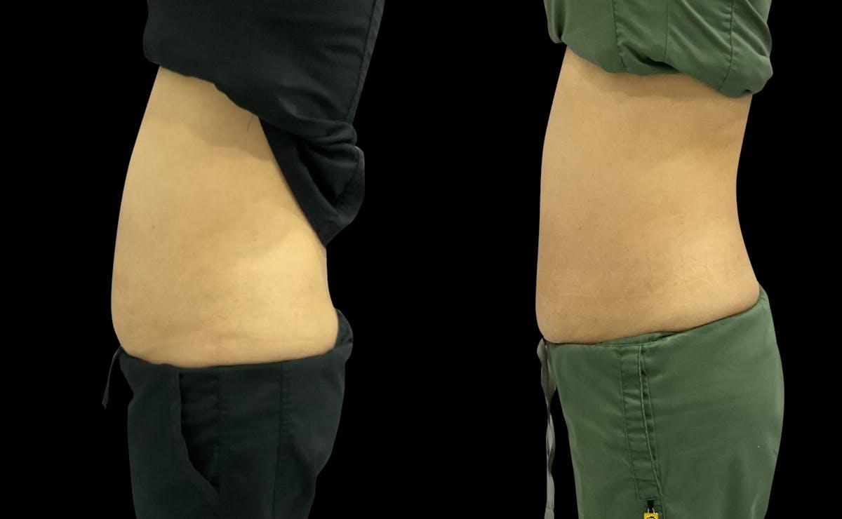 Skin Tightening Before & After Gallery - Patient 306348 - Image 1