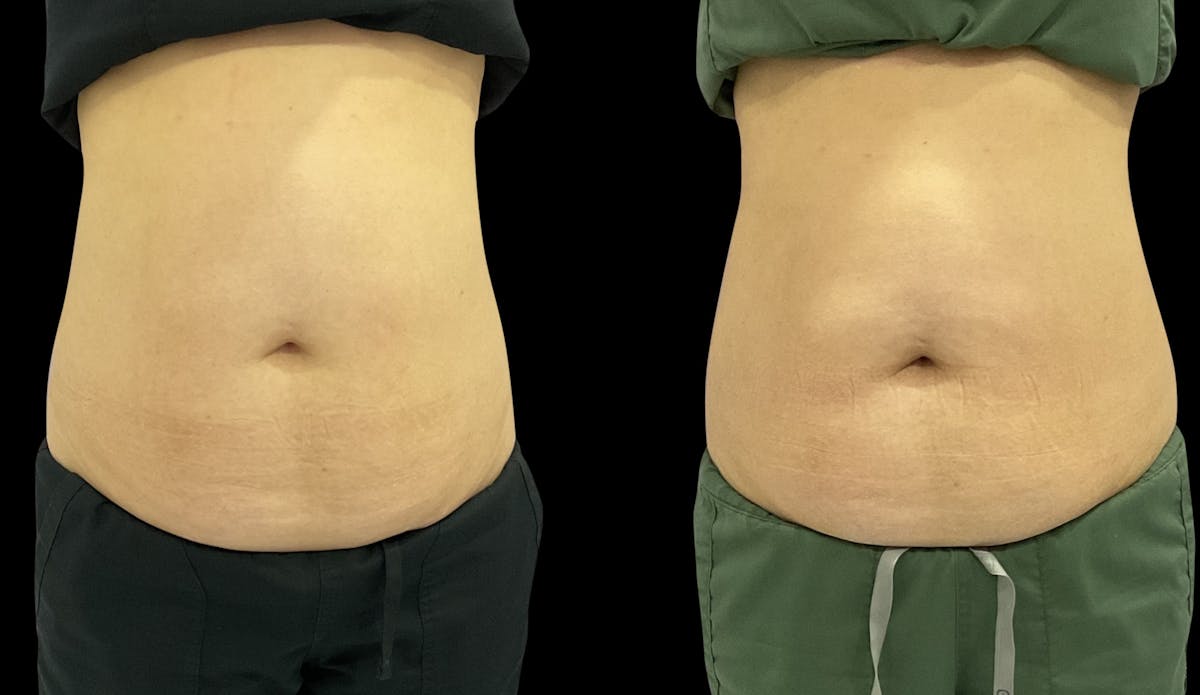 Skin Tightening Before & After Gallery - Patient 306348 - Image 2