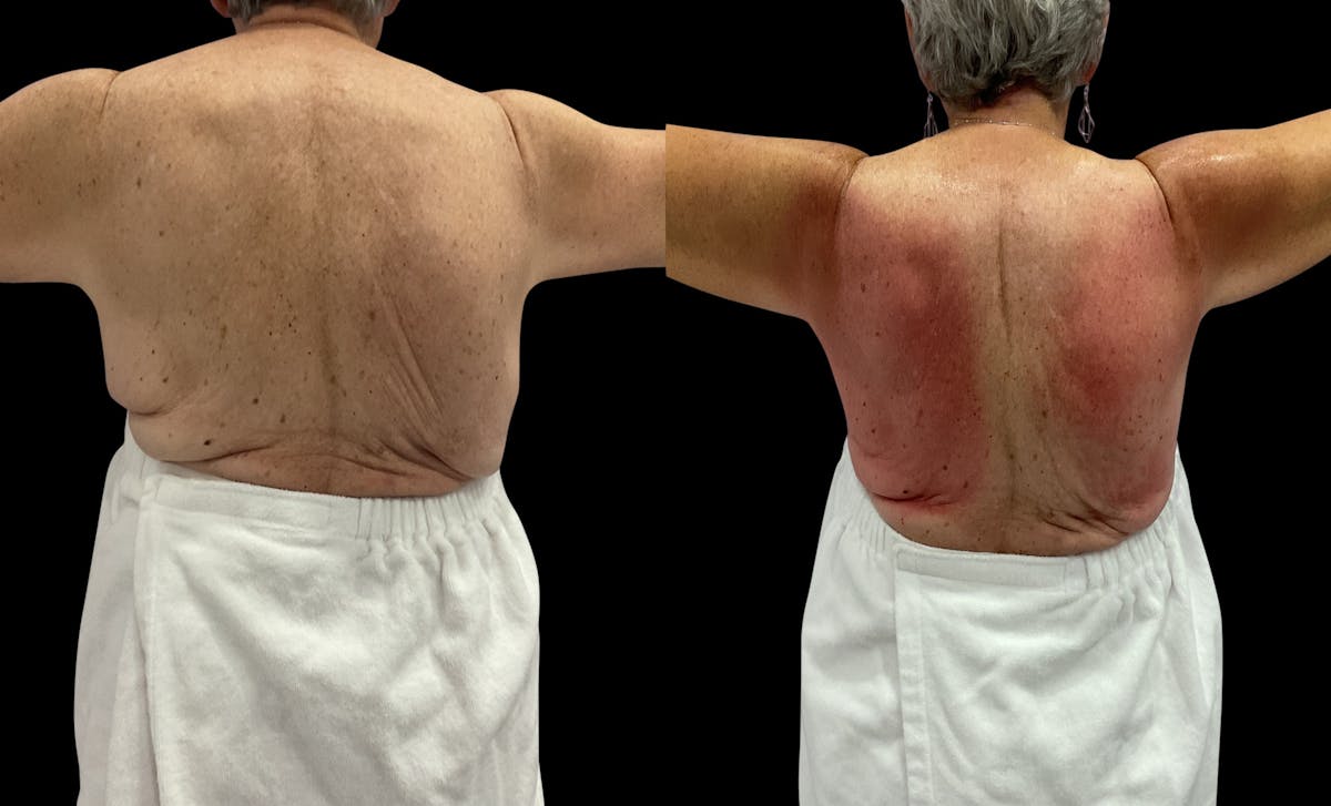 Skin Tightening Before & After Gallery - Patient 122549 - Image 1