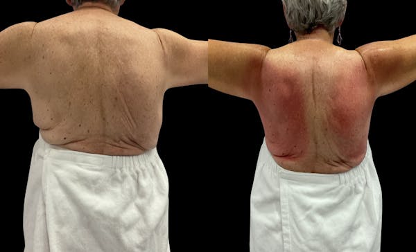 Skin Tightening Before & After Gallery - Patient 122549 - Image 1