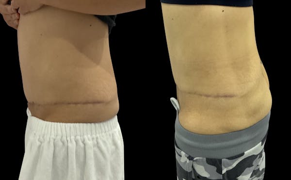 Skin Tightening Before & After Gallery - Patient 262058 - Image 1