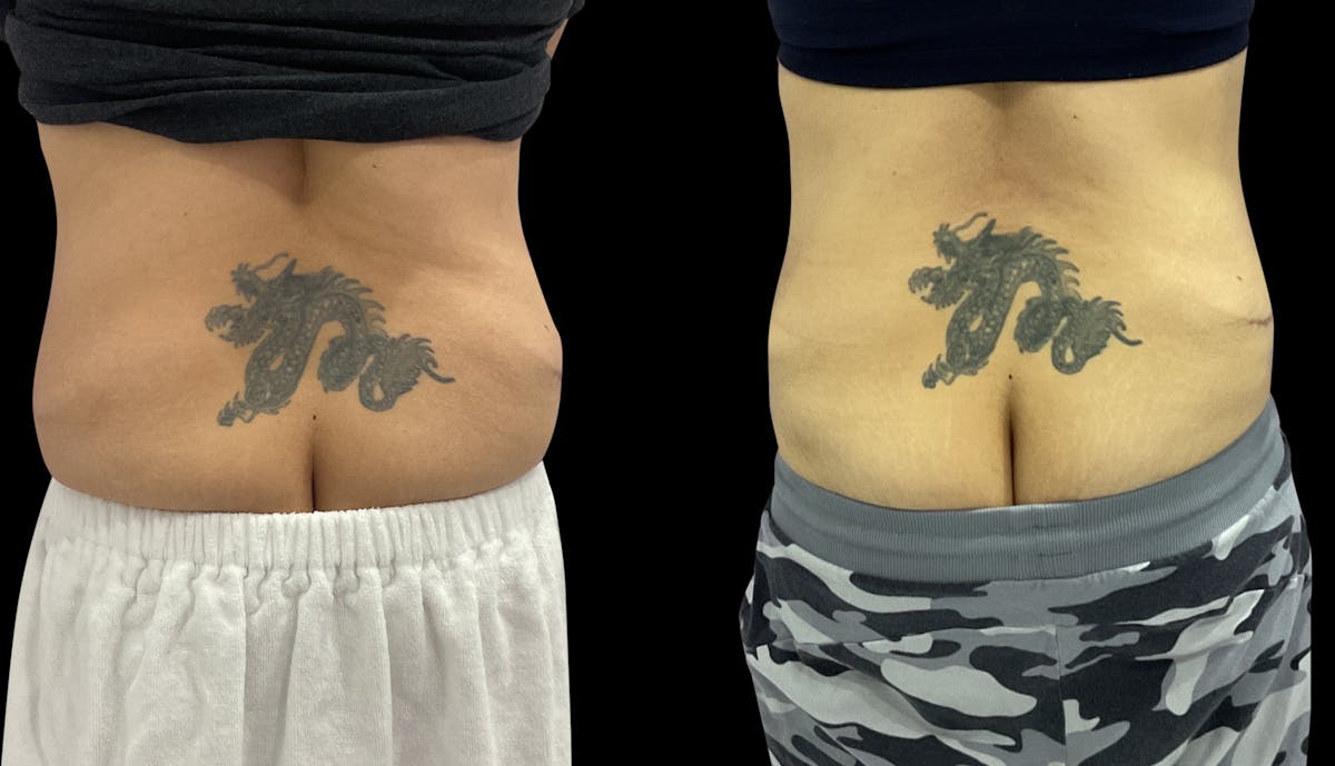 Skin Tightening Before & After Gallery - Patient 262058 - Image 4