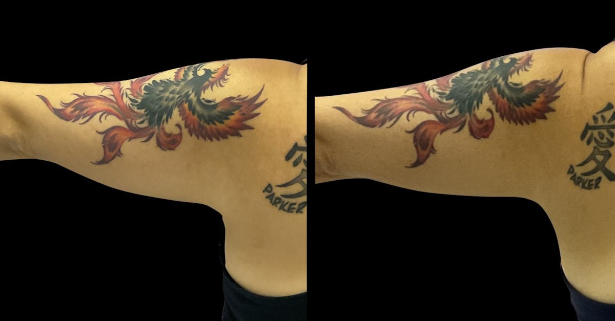 Skin Tightening Before & After Gallery - Patient 262058 - Image 2