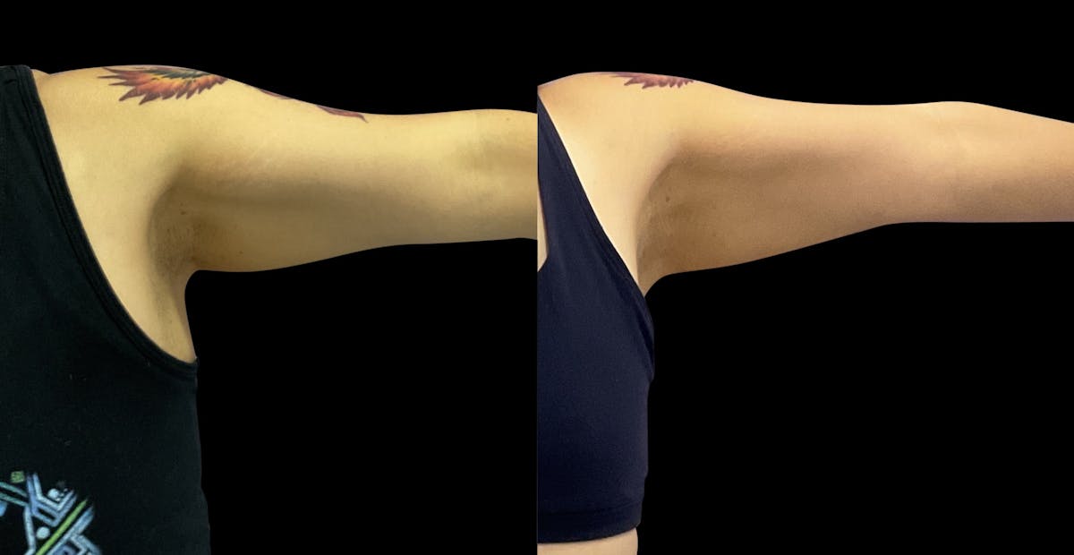 Skin Tightening Before & After Gallery - Patient 262058 - Image 3