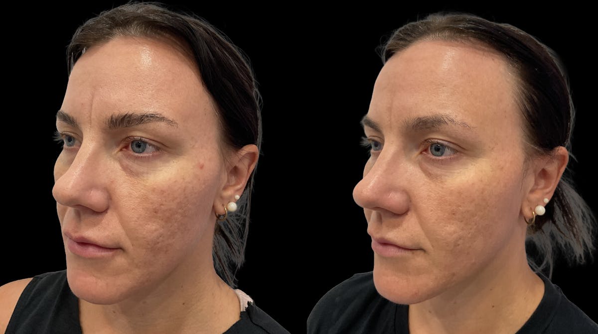 Acne Facial Before & After Gallery - Patient 239748 - Image 1