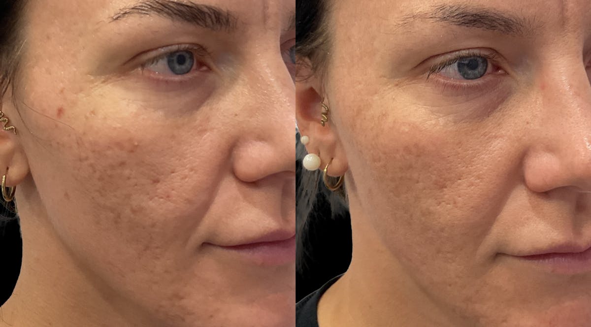 Acne Facial Before & After Gallery - Patient 239748 - Image 3
