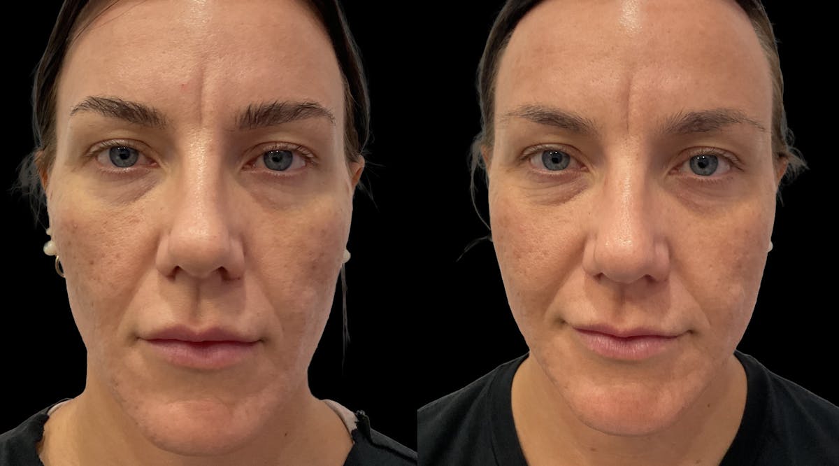 Acne Facial Before & After Gallery - Patient 239748 - Image 2