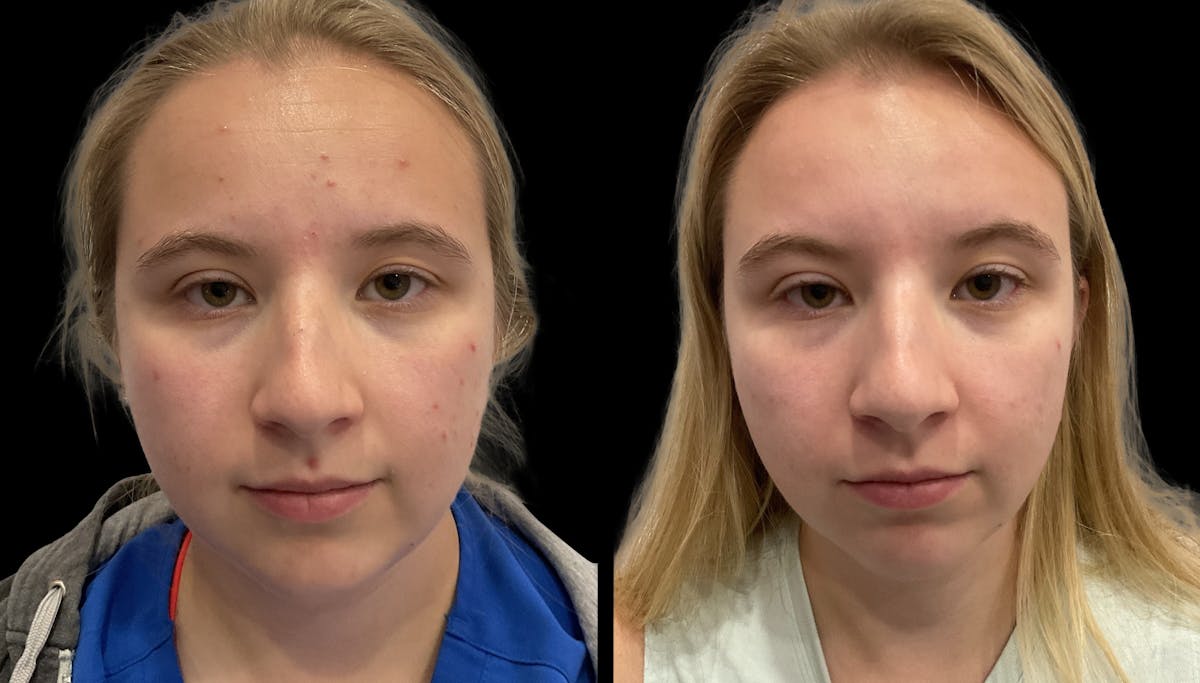 Chemical Peels Before & After Gallery - Patient 247499 - Image 2