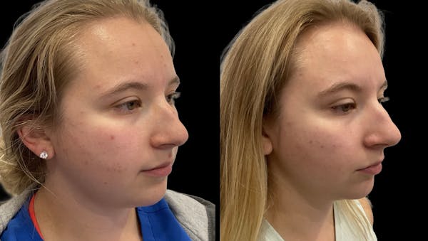 Chemical Peels Before & After Gallery - Patient 247499 - Image 1