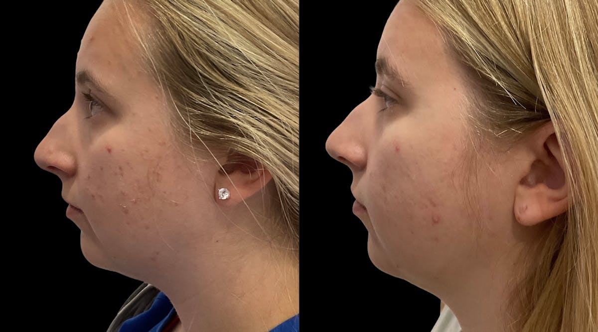 Chemical Peels Before & After Gallery - Patient 247499 - Image 3