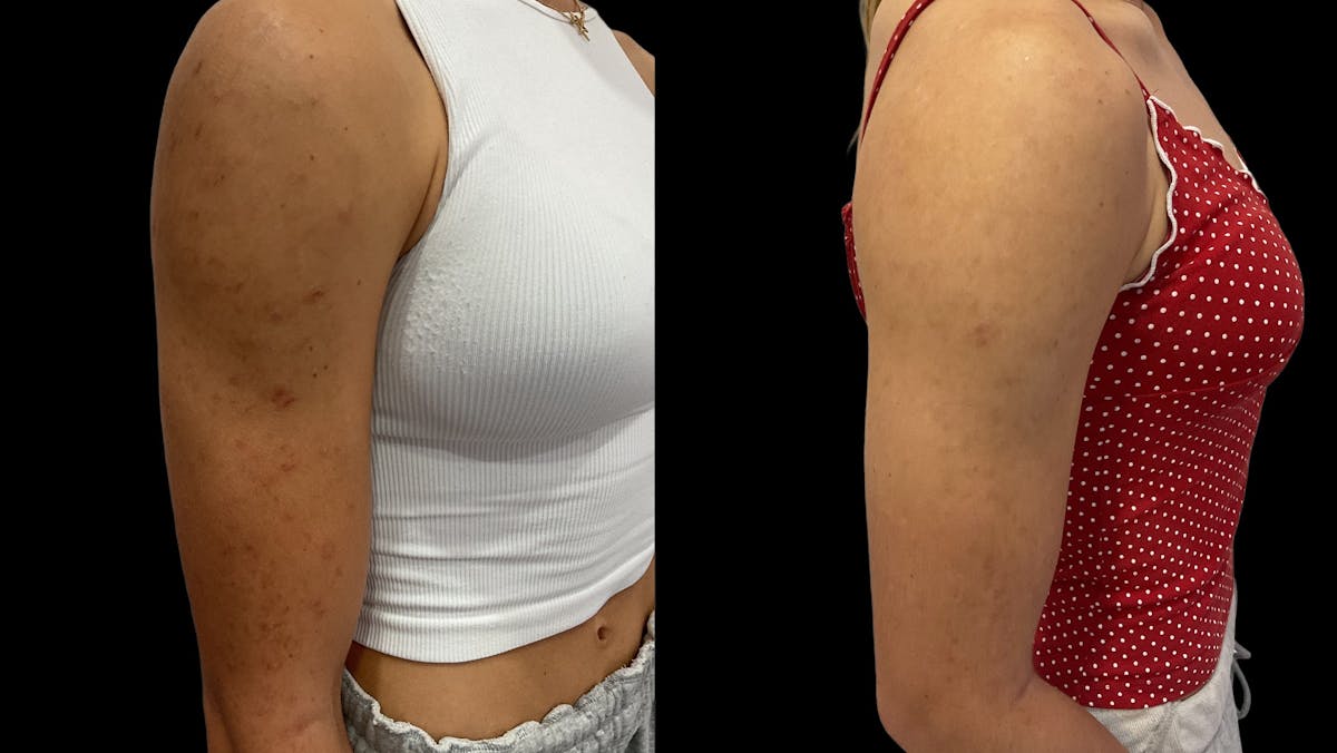 Chemical Peels Before & After Gallery - Patient 424359 - Image 1