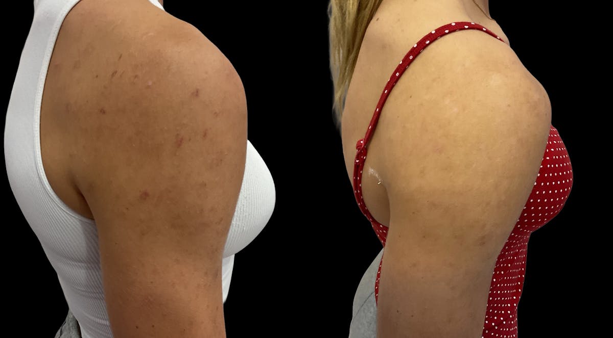 Chemical Peels Before & After Gallery - Patient 424359 - Image 2