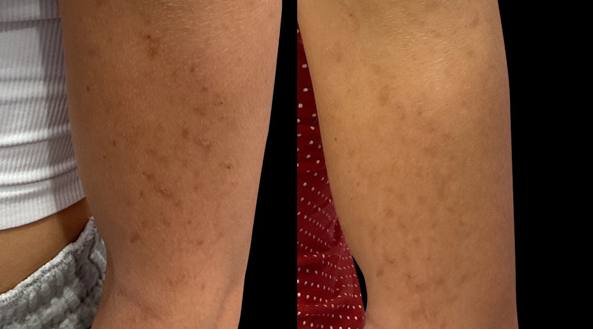 Chemical Peels Before & After Gallery - Patient 424359 - Image 4