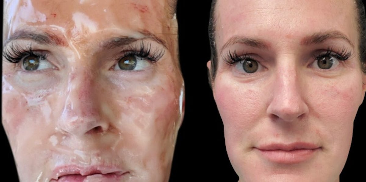 CO2 Lift Pro Mask Before & After Gallery - Patient 151280 - Image 2