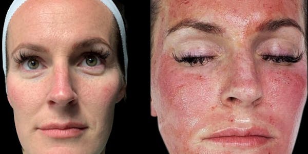 CO2 Lift Pro Mask Before & After Gallery - Patient 151280 - Image 1
