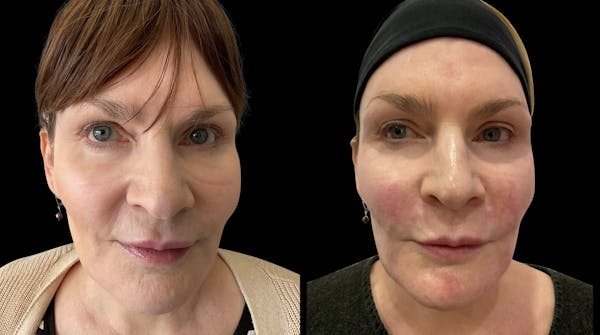 Dermal Filler Before & After Gallery - Patient 181533 - Image 1