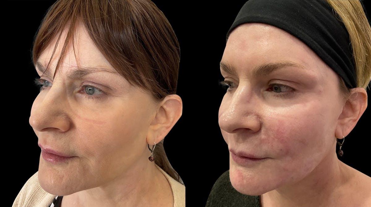 Dermal Filler Before & After Gallery - Patient 181533 - Image 2