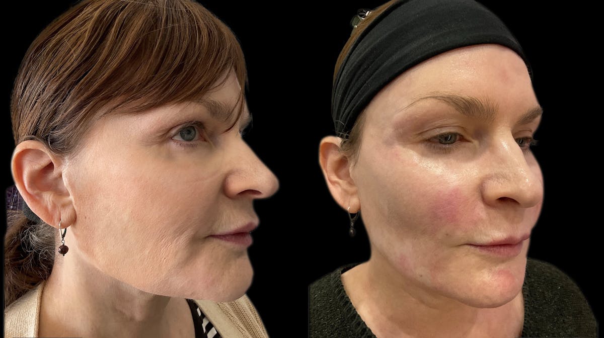 Dermal Filler Before & After Gallery - Patient 181533 - Image 3